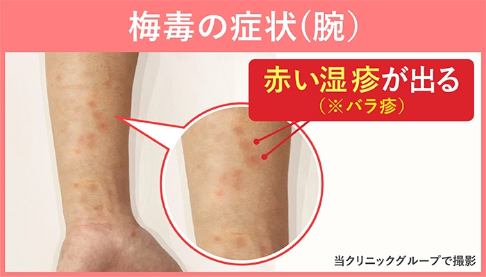 梅毒2期バラ疹が発症している男性上腕の症例写真