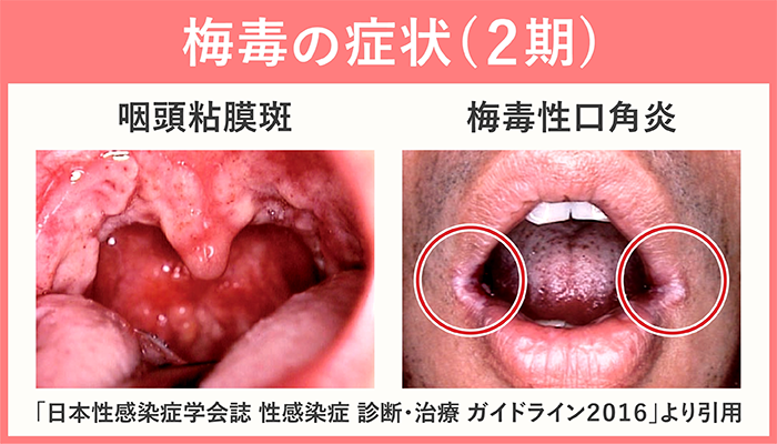 梅毒2期の症状 咽頭粘膜斑の梅毒性口角炎の症例写真