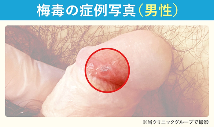 男性陰部の梅毒の初期硬結の症例写真