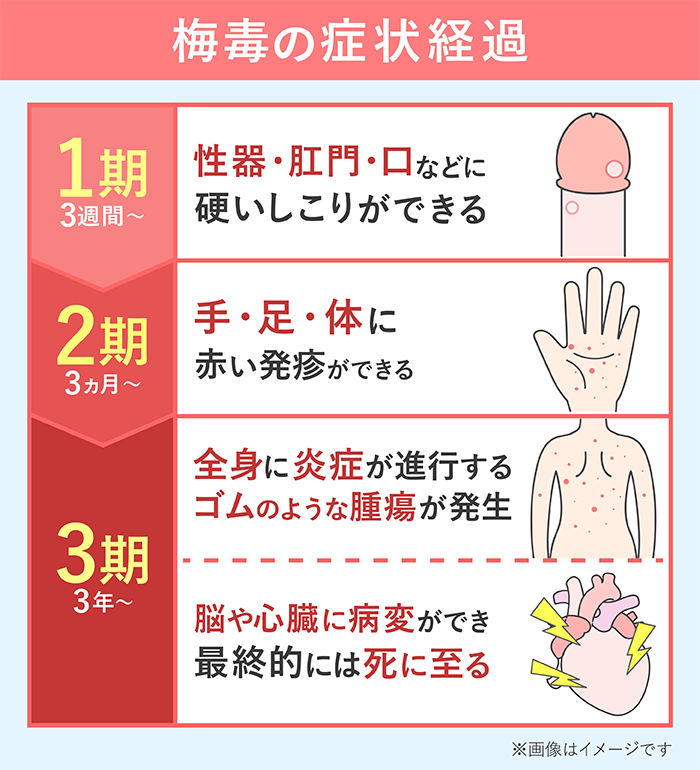 梅毒の症状は病期によって異なる