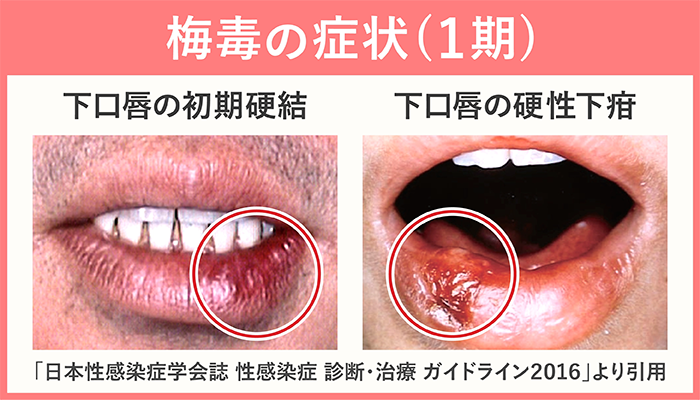 梅毒1期の症状 下口唇の初期硬結 硬性下疳の症例写真