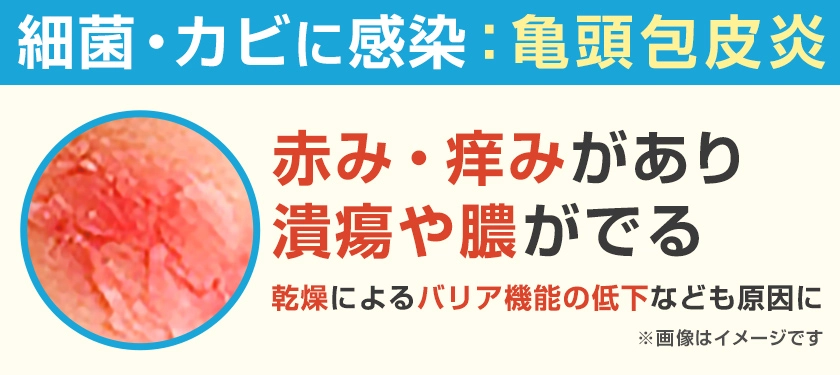 細菌・カビによる感染が原因　亀頭包皮炎