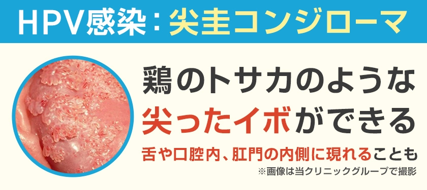 HPV感染による尖圭コンジローマ