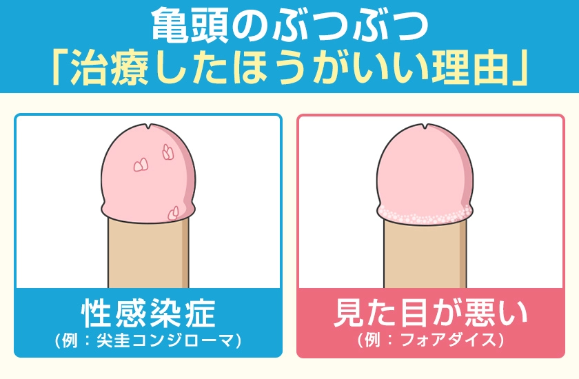 亀頭のぶつぶつを治療したほうがいい理由