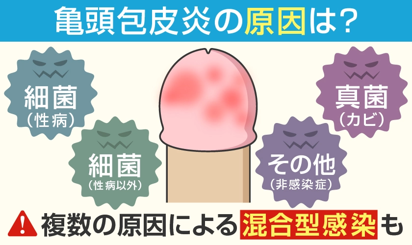 亀頭包皮炎の主な原因は、細菌・真菌など　複数の原因による混合型感染も