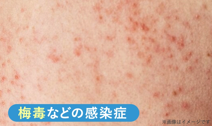 性感染症によってお尻にぶつぶつが発症している様子のイメージ画像