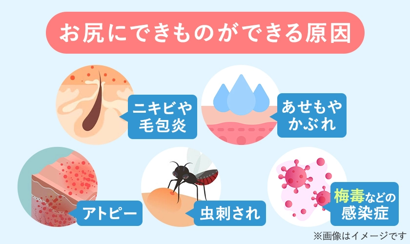 お尻にぶつぶつができる原因の一覧