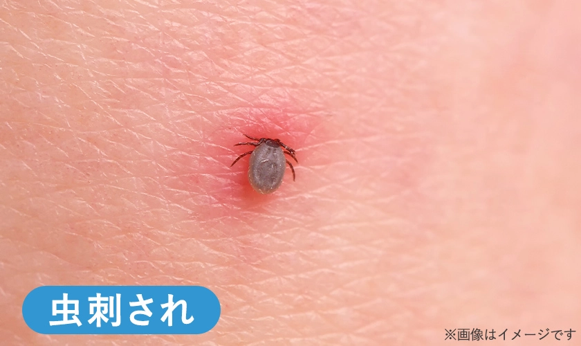 お尻の虫刺されのイメージ画像