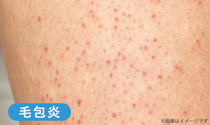 お尻の毛包炎のイメージ画像