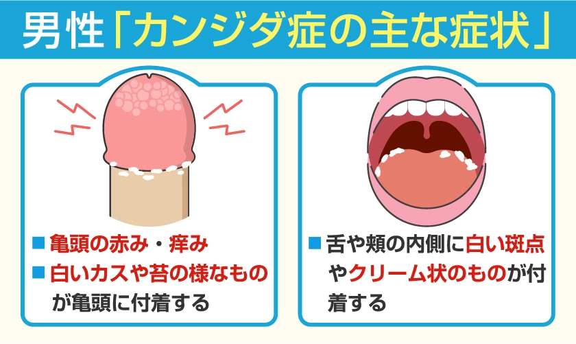 男性のカンジダ症の主な症状　亀頭の赤み・痒み・舌や頬の内側に、白い斑点やクリーム状の苔のようなものが付着 