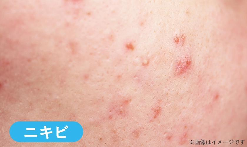 お尻のニキビのイメージ画像