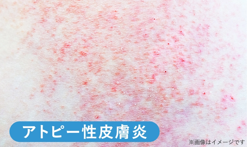 お尻のアトピー性皮膚炎のイメージ画像