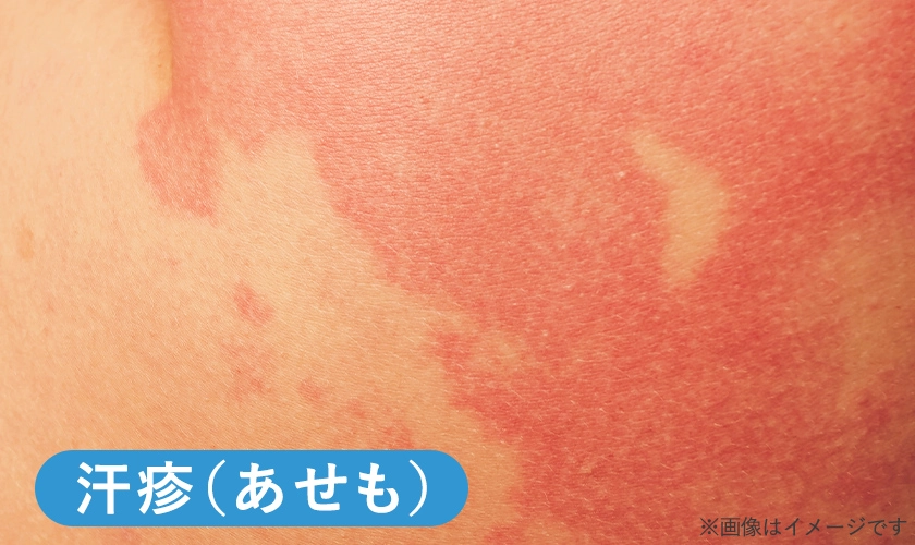 お尻の汗疹のイメージ画像