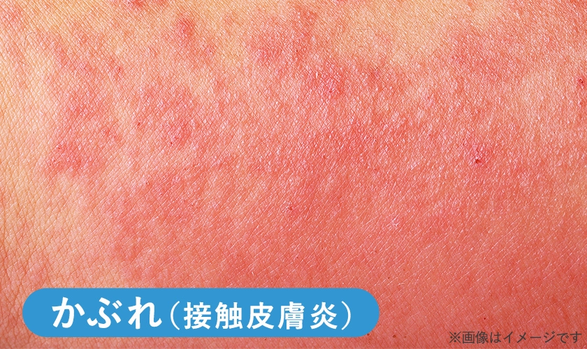 お尻のかぶれのイメージ画像