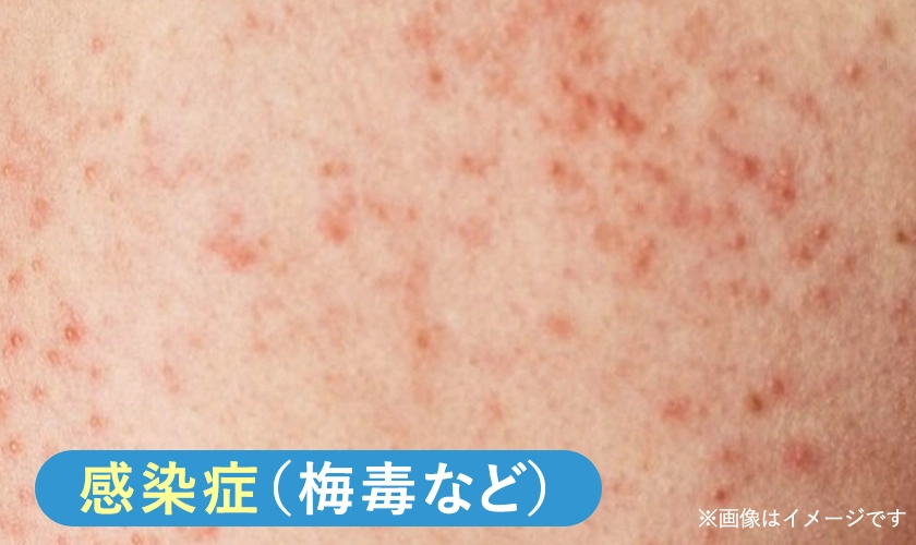 性感染症によってお尻にぶつぶつが発症している様子のイメージ画像 梅毒など