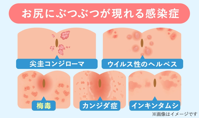 お尻にぶつぶつができる性感染症一覧