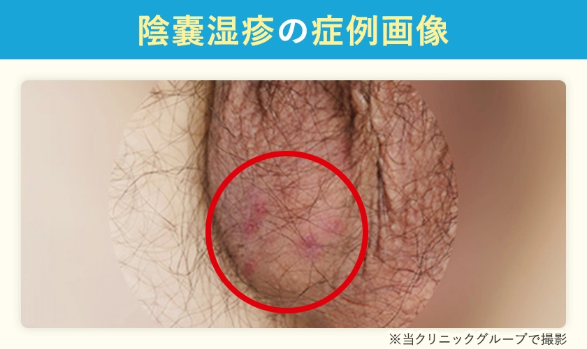 陰嚢湿疹の症例画像