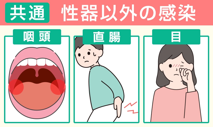 淋菌感染症（淋病）の性器以外の症状　咽頭・直腸・目などにも感染