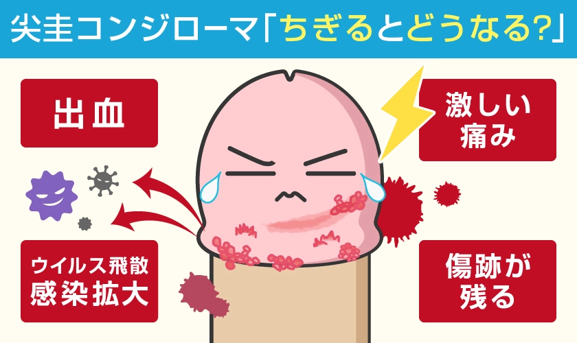 コンジローマをちぎるとどうなる？コンジローマをちぎった場合のリスク