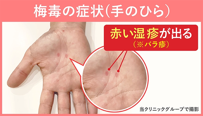 梅毒2期の症状であるバラ疹｜男性の手のひらの症例写真