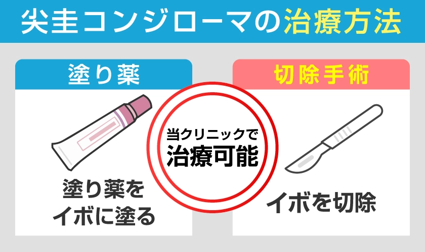 尖圭コンジローマの治療法　塗り薬をイボに塗る　切除手術でイボを除去