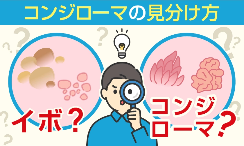 コンジローマの見分け方は？
