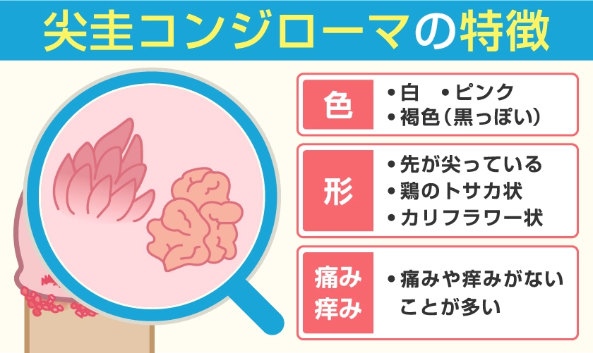 尖圭コンジローマの特徴