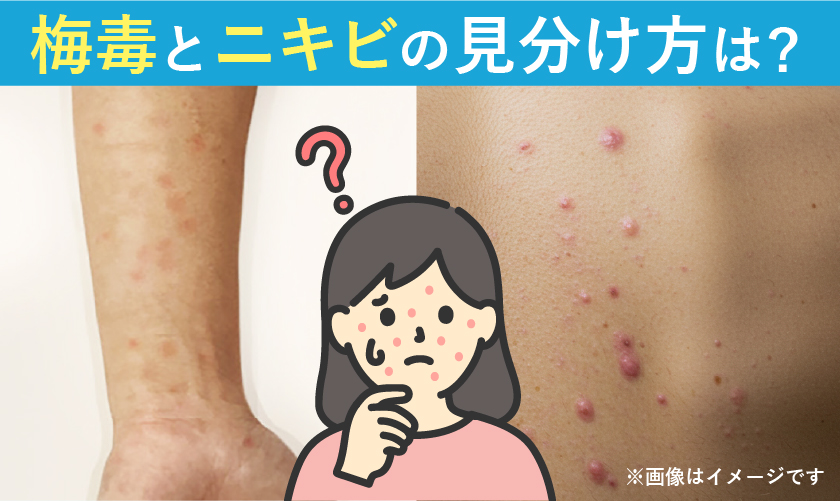 梅毒とニキビの見分け方は？