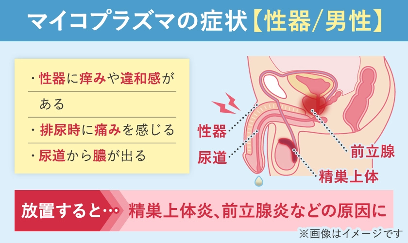 マイコプラズマ（性病）の男性の症状と発生部位